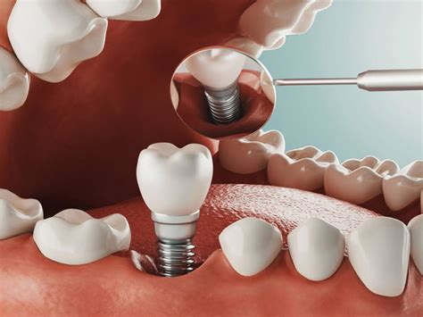 dentures in sioux city iowa|Affordable Dentures & Implants in Sioux City, IA.